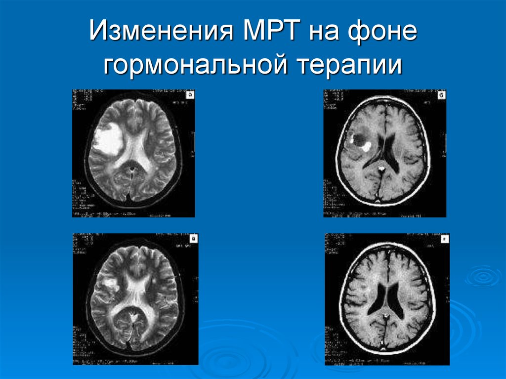 Мрт диагностика рассеянного склероза