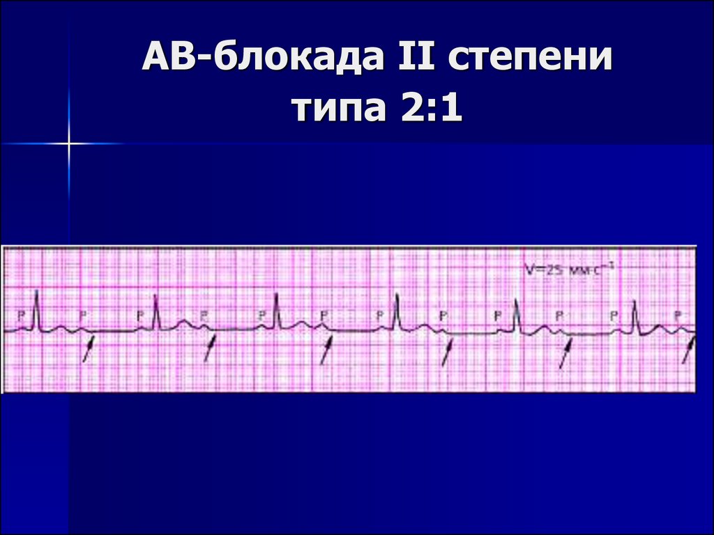 Ав блокада степени