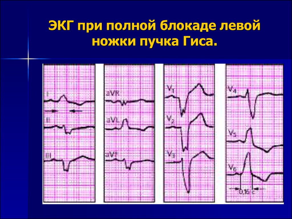 Полная блокада левой ножки карта вызова