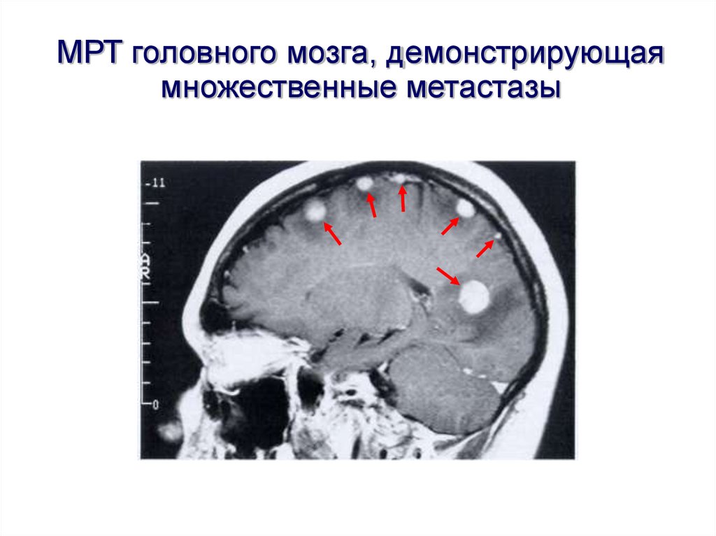 Метастазы головного мозга фото