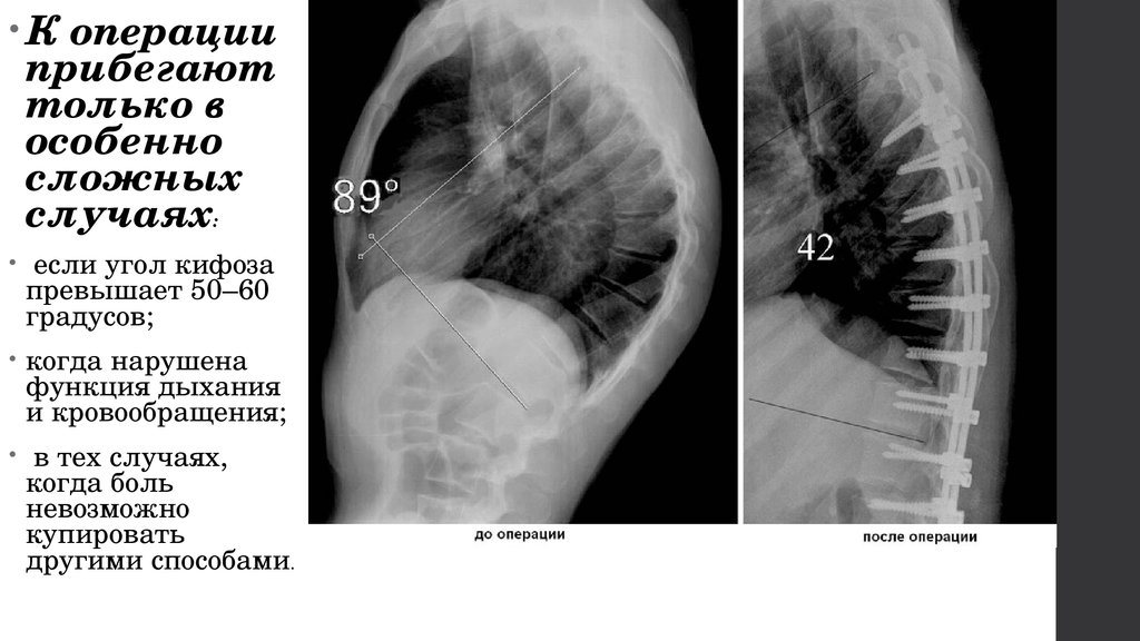 Степени кифоза. Грудной кифоз степени рентген. Операция при болезни Шейермана МАУ. - Гиперкифоз (болезнь Шейермана-МАУ). Угол кифоза грудного отдела позвоночника рентген.