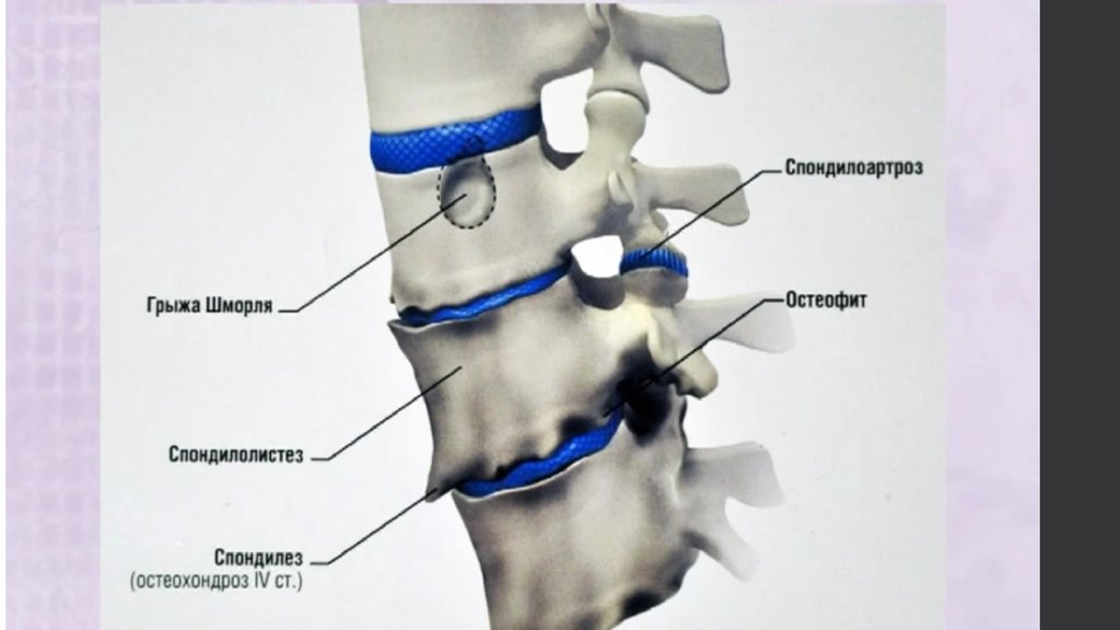 Спондилоартроз что. Спондилез и спондилолистез. Спондилолистез и спондилоартроз.