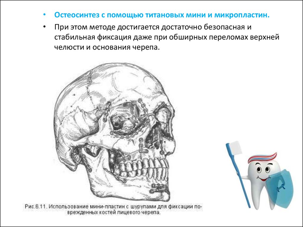 Переломы костей верхней челюсти. Перелом скуловой кости верхней челюсти. Метод Адамса перелом верхней челюсти. Метод Адамса при переломе верхней челюсти. Остеосинтез по Фальтину Адамсу.