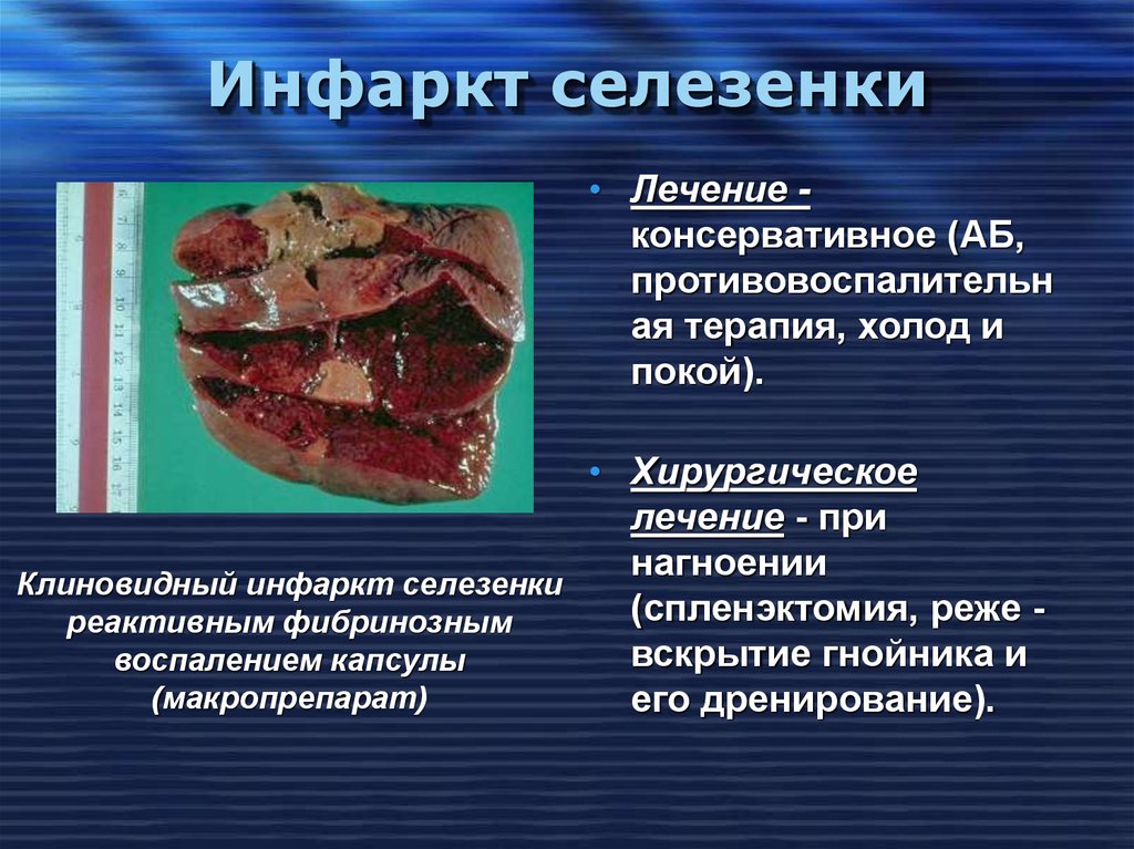 Увеличенная селезенка симптомы лечение. Анемический инфаркт селезенки. Инфаркт селезенки терапия консервативное. Профилактика заболеваний селезенки. Лекарство для селезенки.