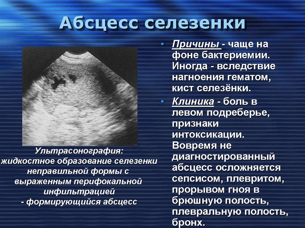 С какой стороны находится селезенка у человека фото и как болит