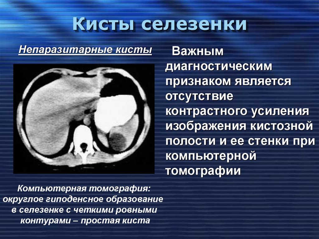 Киста селезенки мкб. Субкапсулярная киста селезенки кт. Селезенка Гиста. Паразитарная киста селезенки на кт.