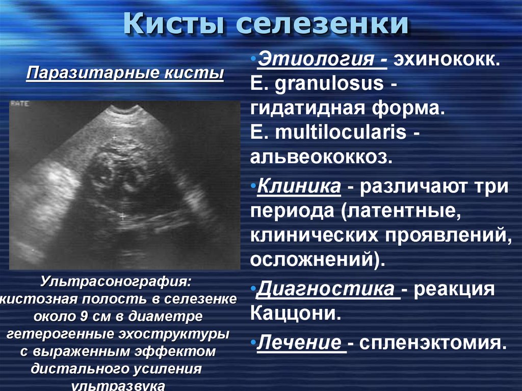 Увеличение селезенки. Кисты селезенки этиология. Паразитарная киста селезенки. Эхинококкоз селезенки. Селезенка симптомы заболевания.