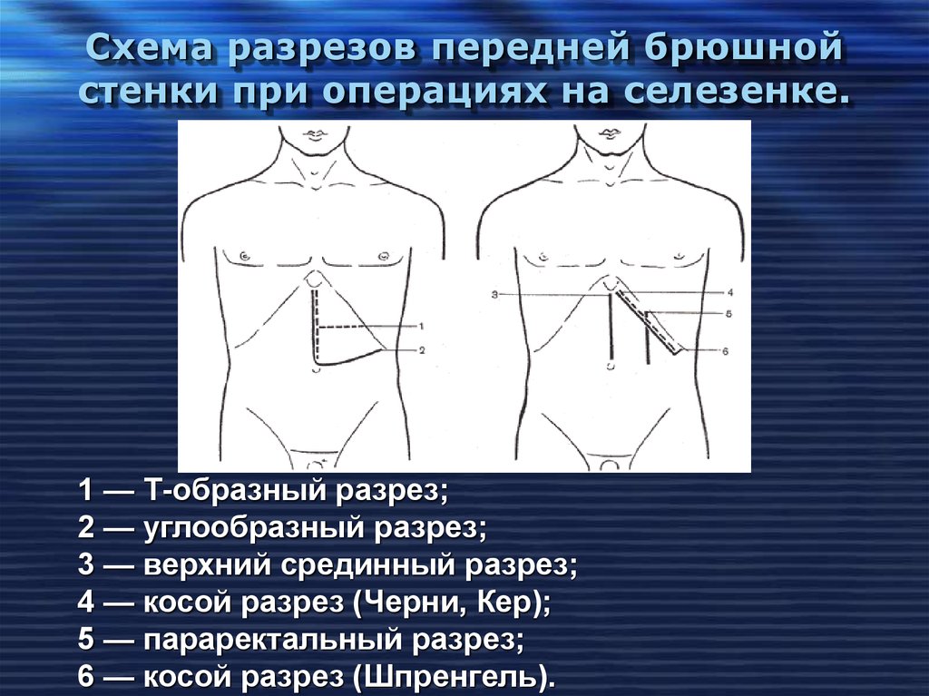 Операции брюшной. Доступ черни Кера к селезенке. Схема разрезов передней брюшной стенки при операциях на селезёнке. Оперативные доступы к селезенке.