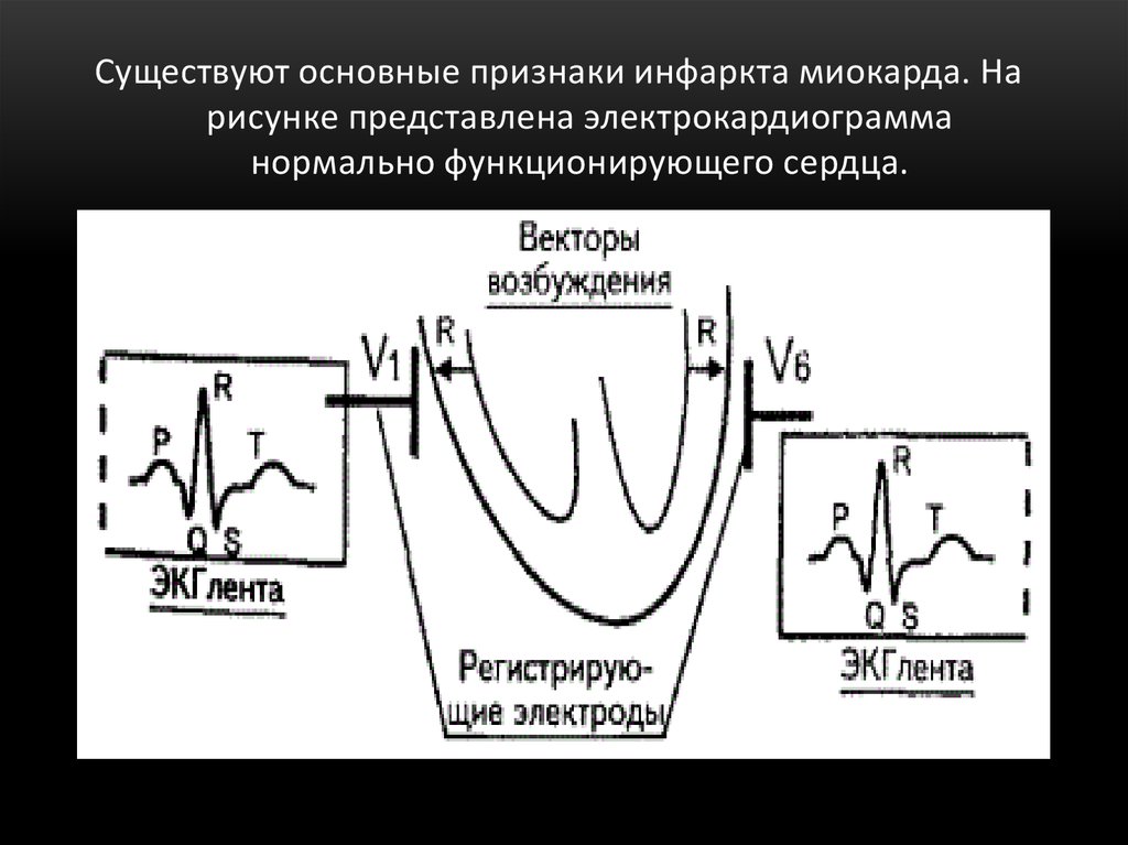 Режим пациента с инфарктом миокарда. ЭКГ критерии инфаркта миокарда. Стадии инфаркта миокарда на ЭКГ. Признаки инфаркта.