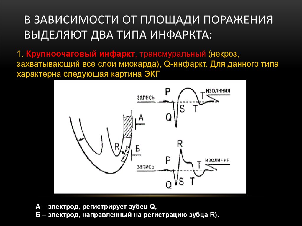 Трансмуральный инфаркт. Острый крупноочаговый инфаркт миокарда. ЭКГ признаки крупноочагового трансмурального инфаркта миокарда. ЭКГ при трансмуральном некрозе. Крупноочаговый трансмуральный инфаркт ЭКГ.