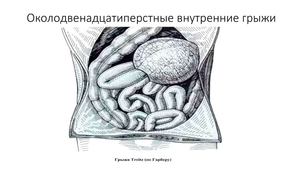 Наружные и внутренние грыжи живота презентация