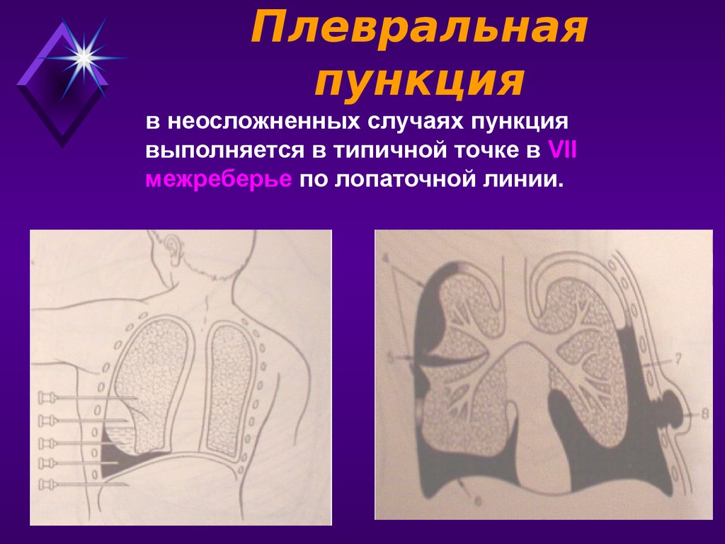 Торакальная хирургия презентация