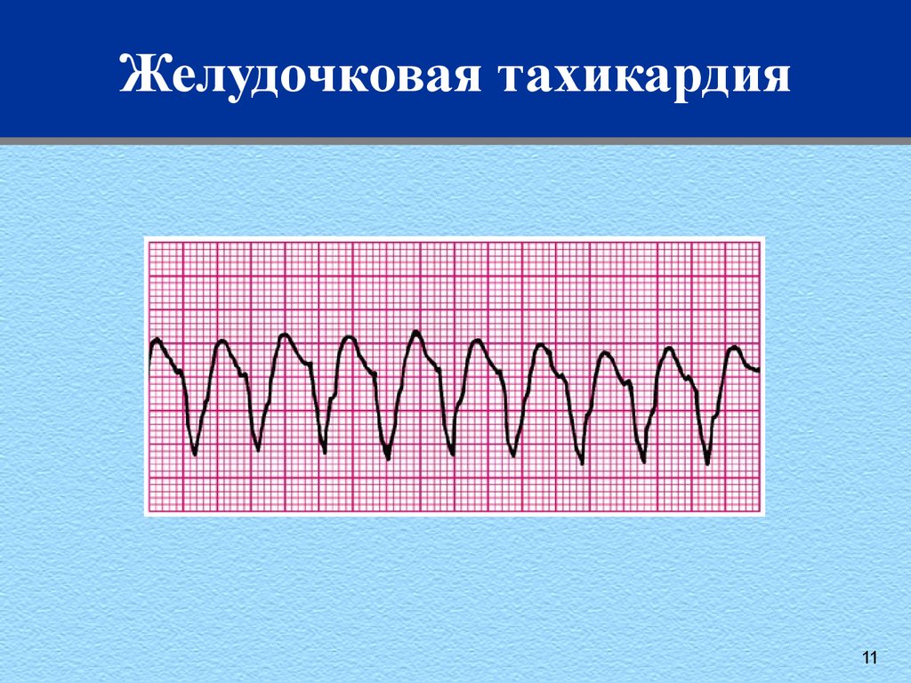 Желудочковая тахикардия картинки