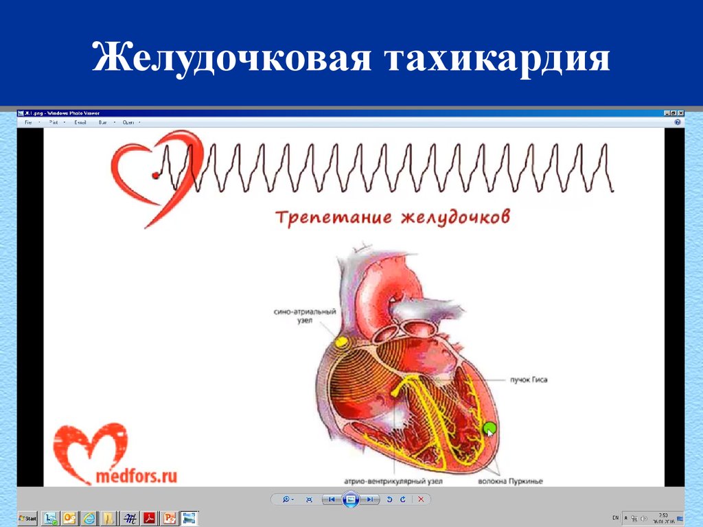 Сердечно легочная недостаточность карта вызова