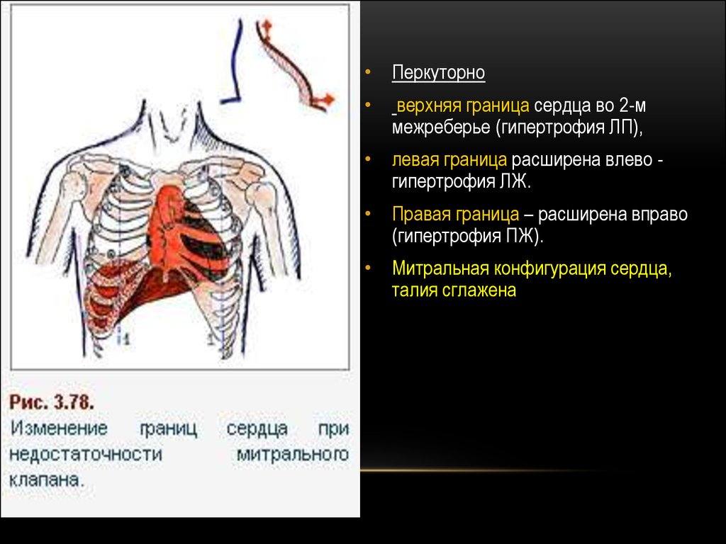 Правая граница. Расширение границ сердца. Расширение границ сердца вправо. Левая граница сердца. Расширение границ сердца влево.