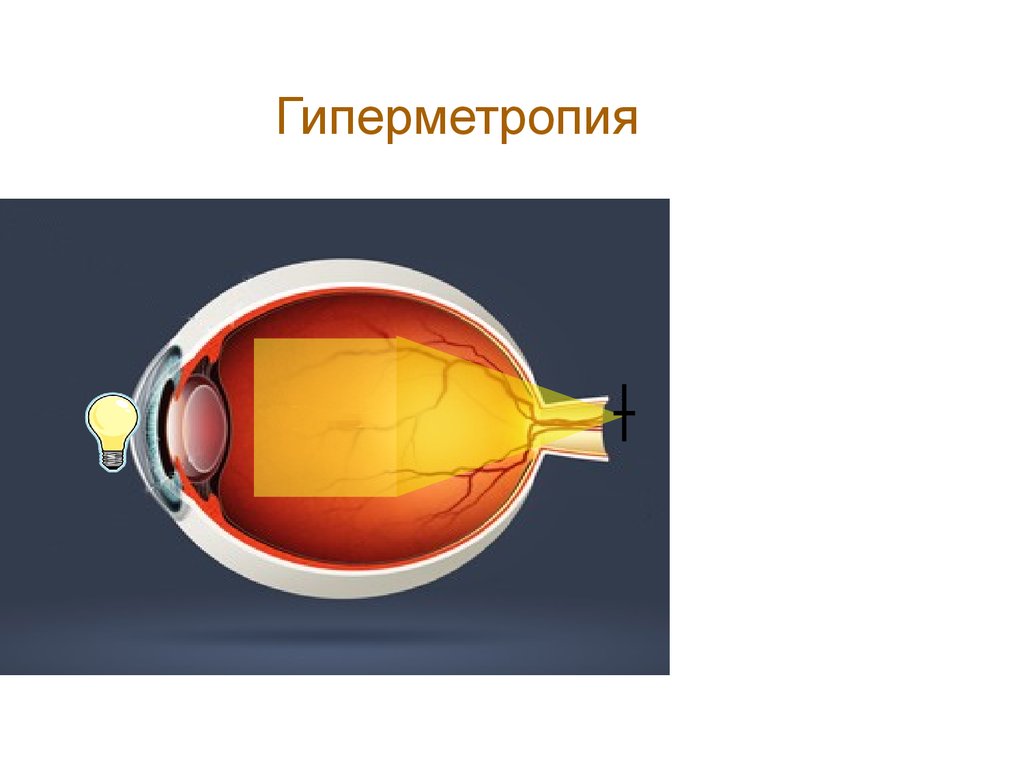 Гиперметропия глаза что это такое. Гиперметропия. Скрытая гиперметропия. Механизм гиперметропии. Осложнения гиперметропии.