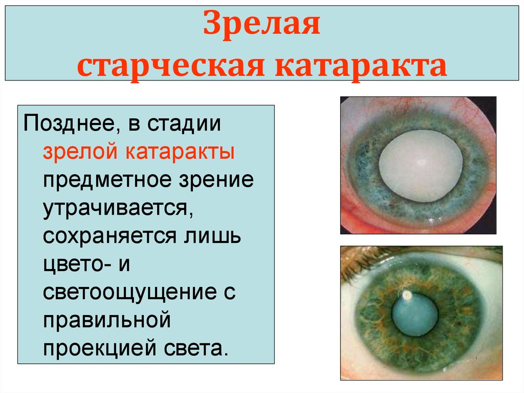 Презентация по офтальмологии катаракта