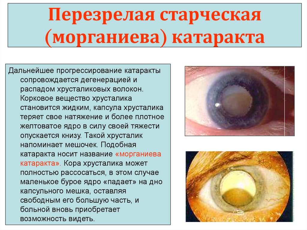 Что можно делать после катаракты. Катаракта морганиева катаракта. Сенильная катаракта стадии. Возрастная катаракта помутнение хрусталика. Капсулярная врожденная катаракта.