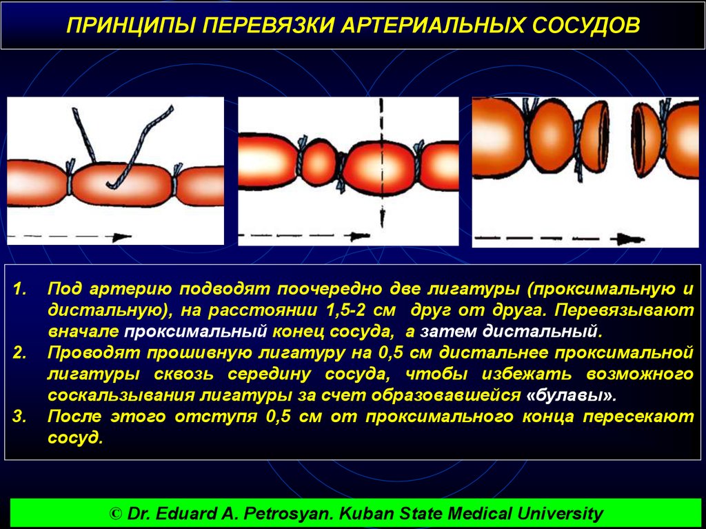 Перевязка в ране и на протяжении. Перевязка сосуда на протяжении. Наложение лигатуры на артерию. Перевязка артерии на протяжении.