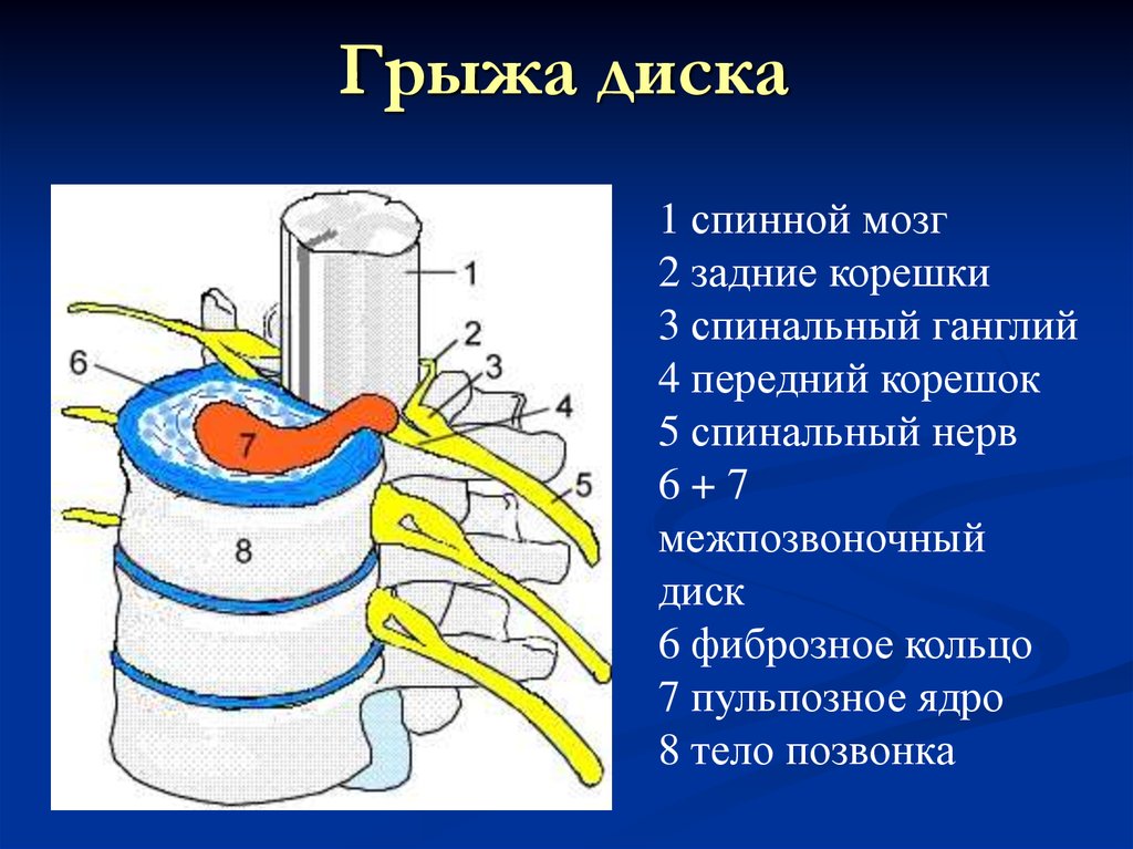 Диски спинного мозга. Спинной мозг корешки спинальные ганглии. Грыжа передавила спинной мозг.