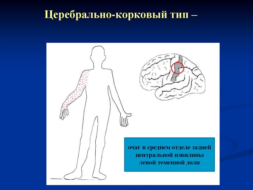 Нарушение ч. Церебральный корковый Тип нарушения чувствительности. Корковый Тип нарушения. Корковый Тип расстройства чувствительности. Типы чувствительных расстройств корковый.