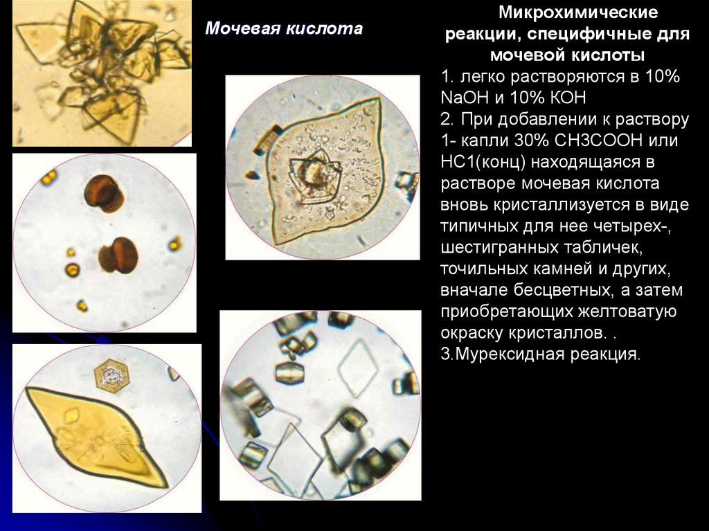 Мочекислый аммоний в моче фото