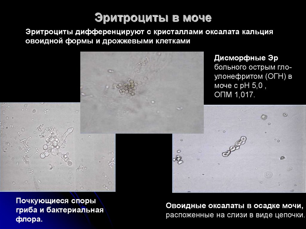 Кристаллы оксалата в моче у мужчин. Эритроциты выщелоченные микроскопия. Оксалаты кальция в осадке мочи. Неизмененные эритроциты в моче микроскопия. Фазовоконтрастная микроскопия мочевого осадка.