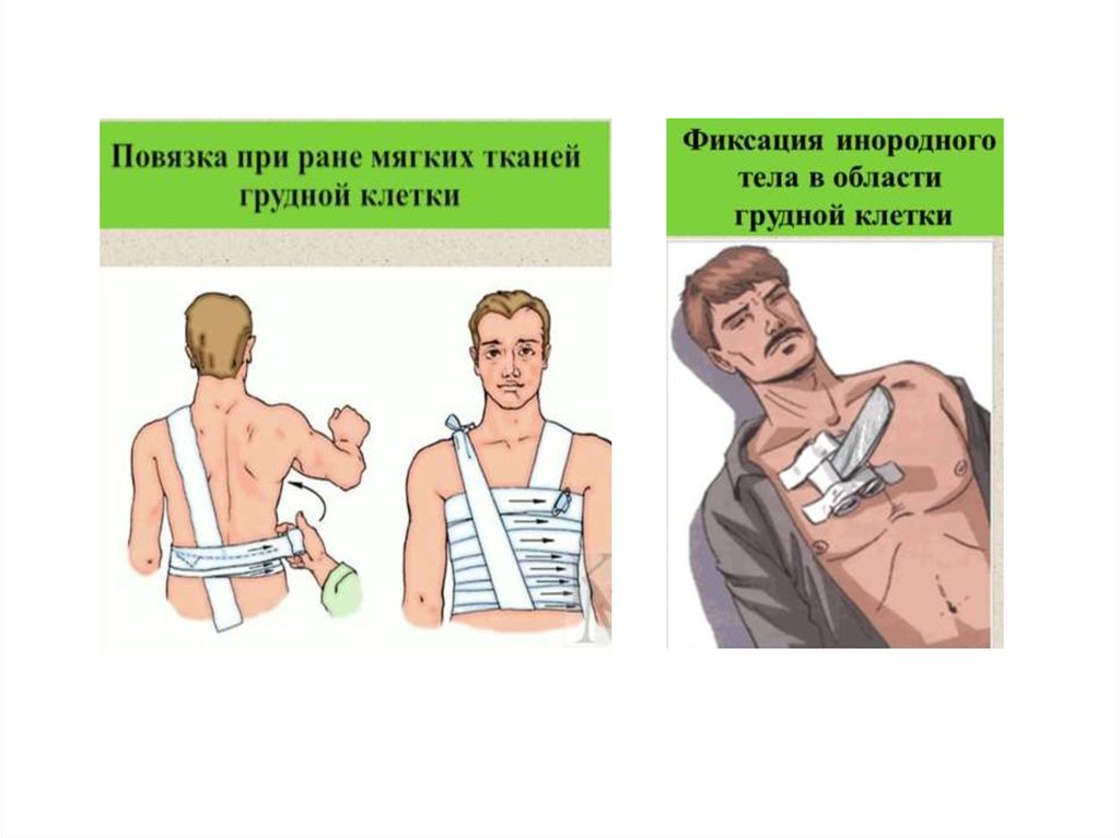 Типы повязок и их назначение - презентация онлайн