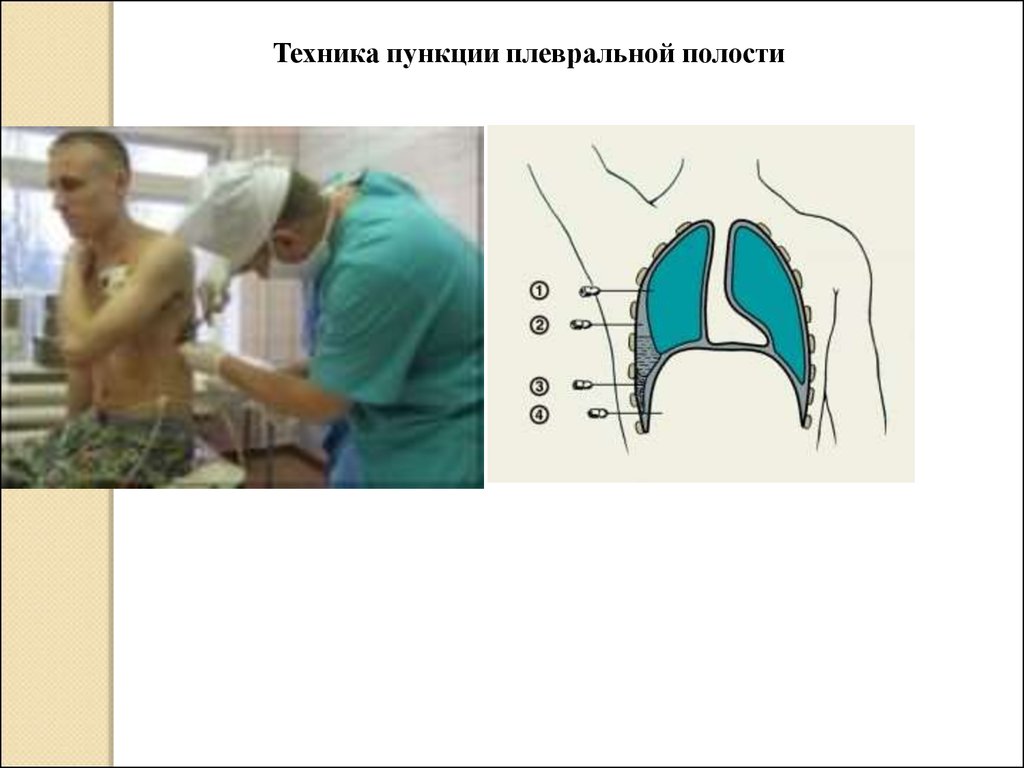 Пункция плевральной полости. Пункция легких алгоритм. Плевральная пункция при пневмотораксе алгоритм. Точка для пункции при Гнойном плеврите:. Техника выполнения плевральной пункции при пневмотораксе алгоритм.