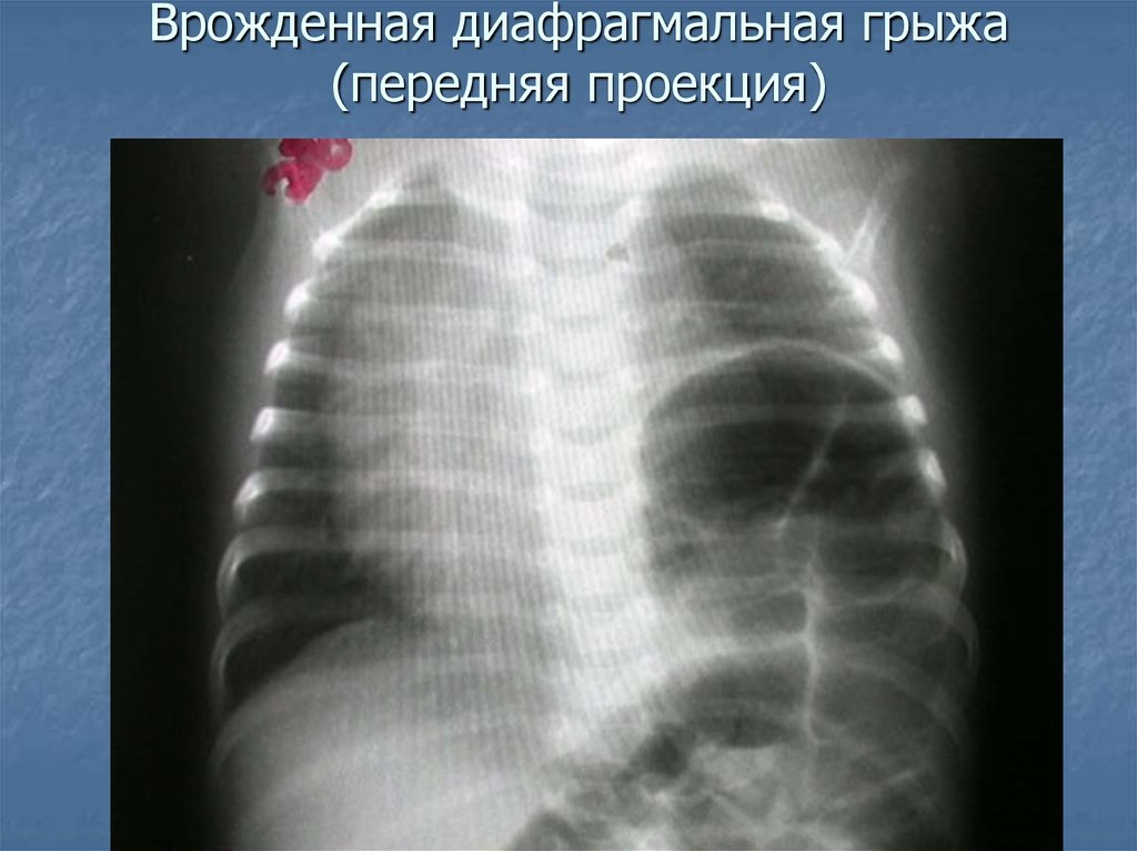 Симптом диафрагмы. Кардиодиафрагмальная грыжа. Врожденная диафрагмальная грыжа рентген. Истинная диафрагмальная грыжа рентген. Грыжа диафрагмы на рентгене грудной клетки.