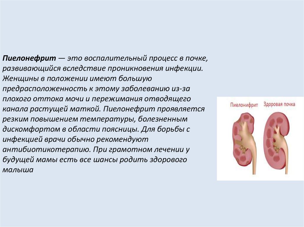 Гестационный пиелонефрит презентация