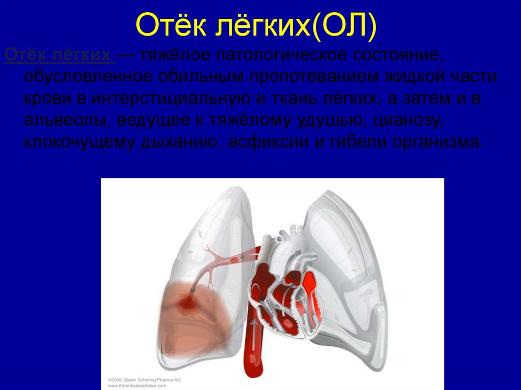 Презентация на тему отек легких