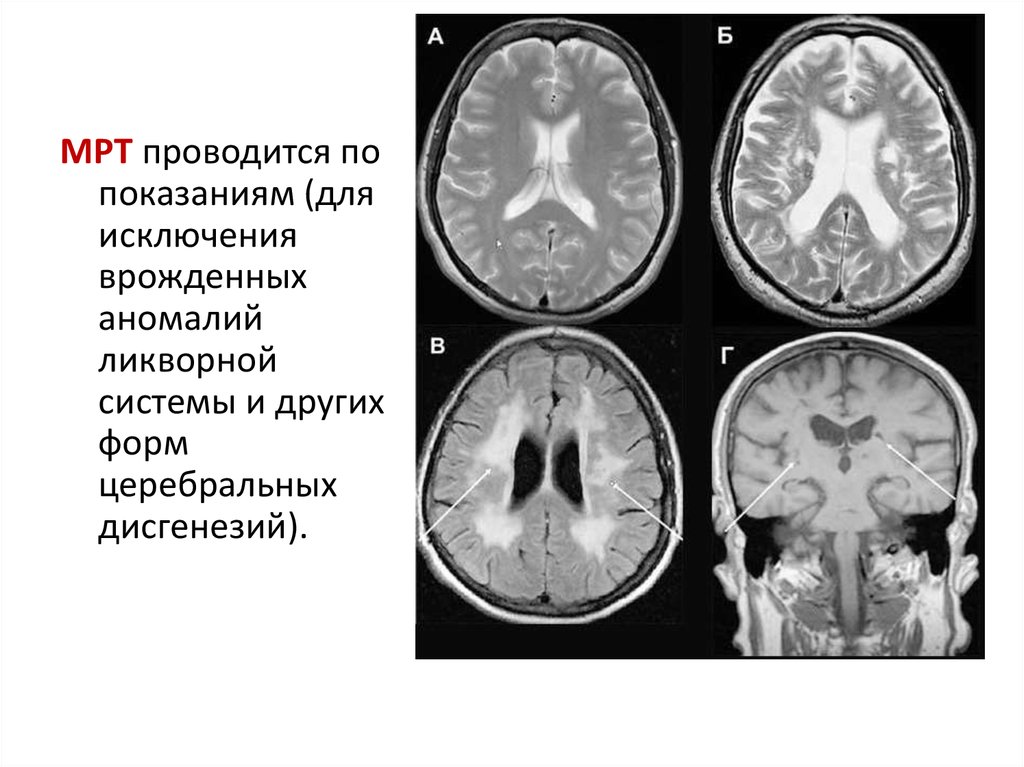 Церебральная гидроцефалия. Микроцефалия головного мозга. Микроцефалия гидроцефалия.