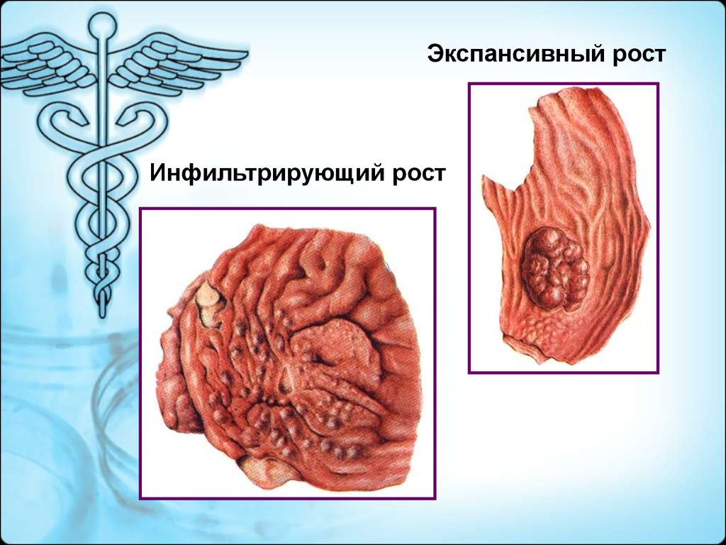 Рост рака. Экспансивный характер роста опухоли. Экзофитный экспансивный рост. Аппозиционный рост опухоли. Ээкспульсивный рост опухоли.