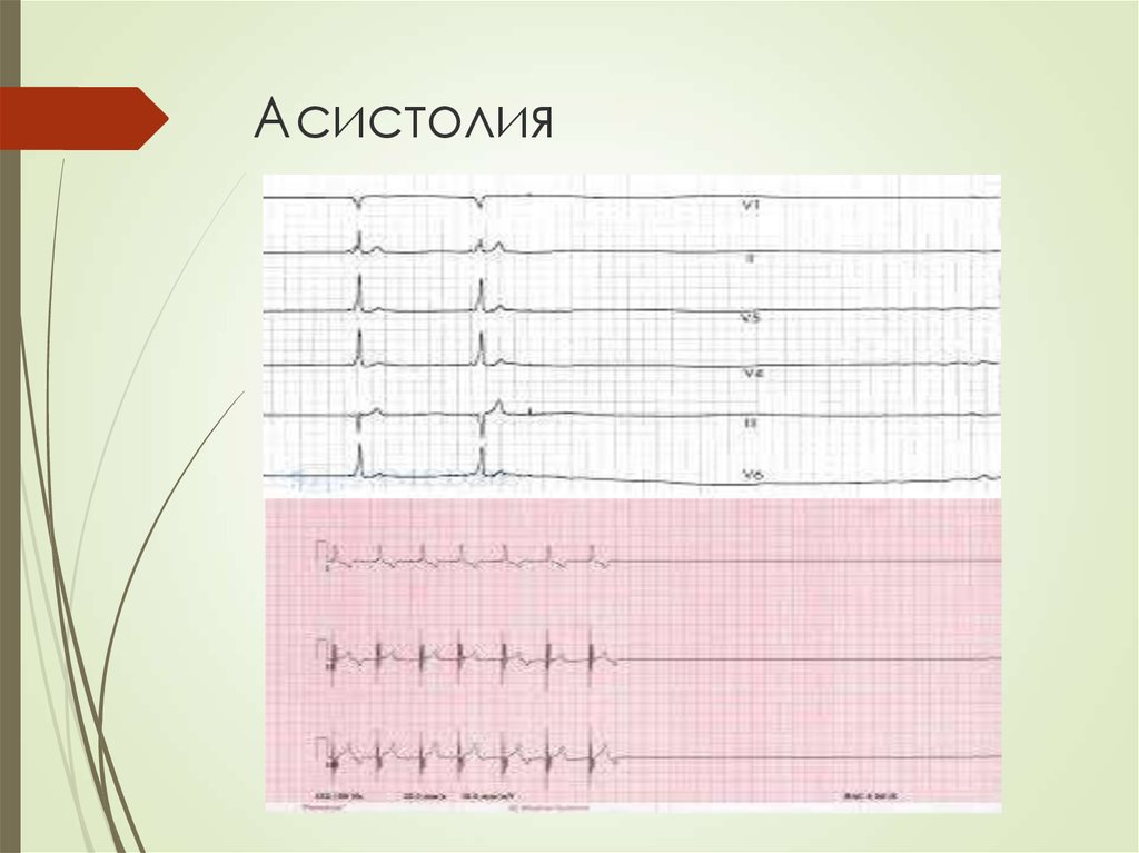 Асистолия на экг фото