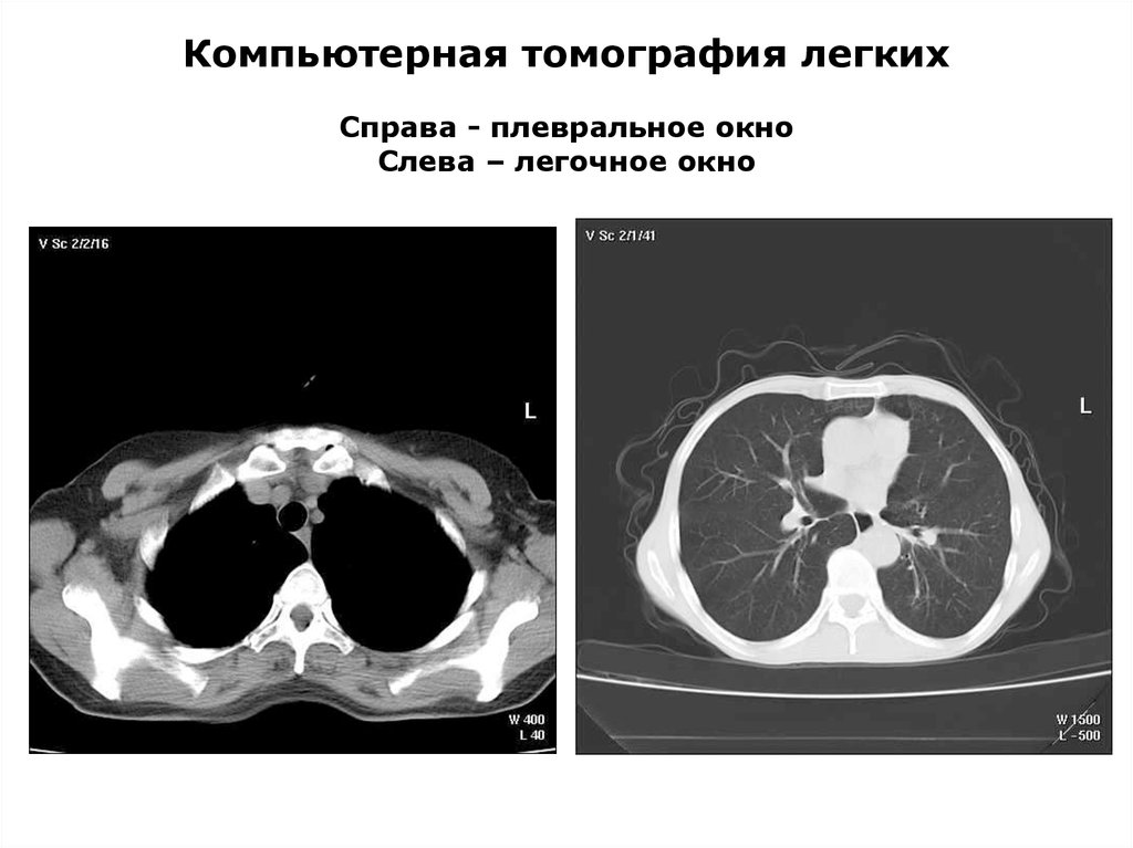 Презентация кт легких