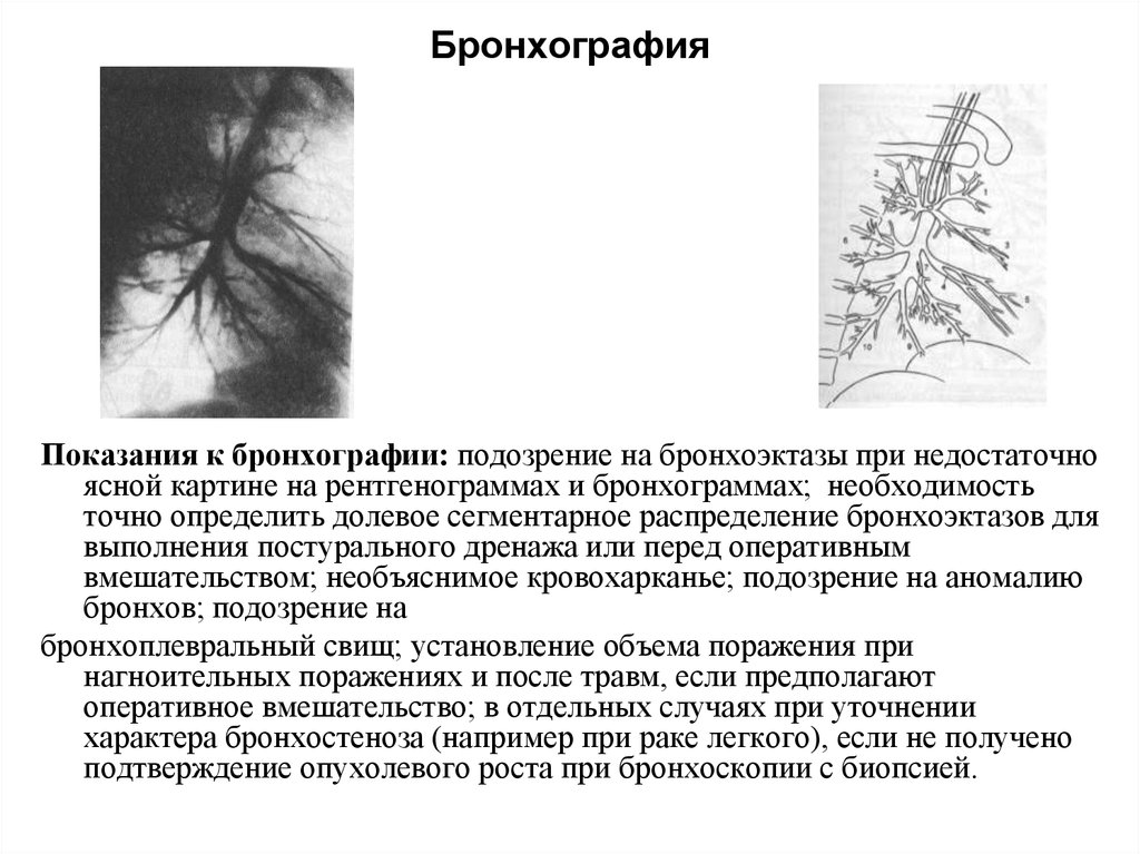 Бронхография. Бронхография патология. Бронхография показания методика проведения. Бронхография методика проведения. Бронхография суть метода.