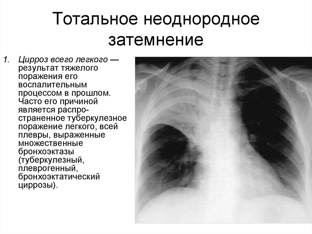 Ли затемнение легких. Тотальная цирроз легкого рентген. Рентген тотальное затемнение легкого. Тотальное поражение легких.