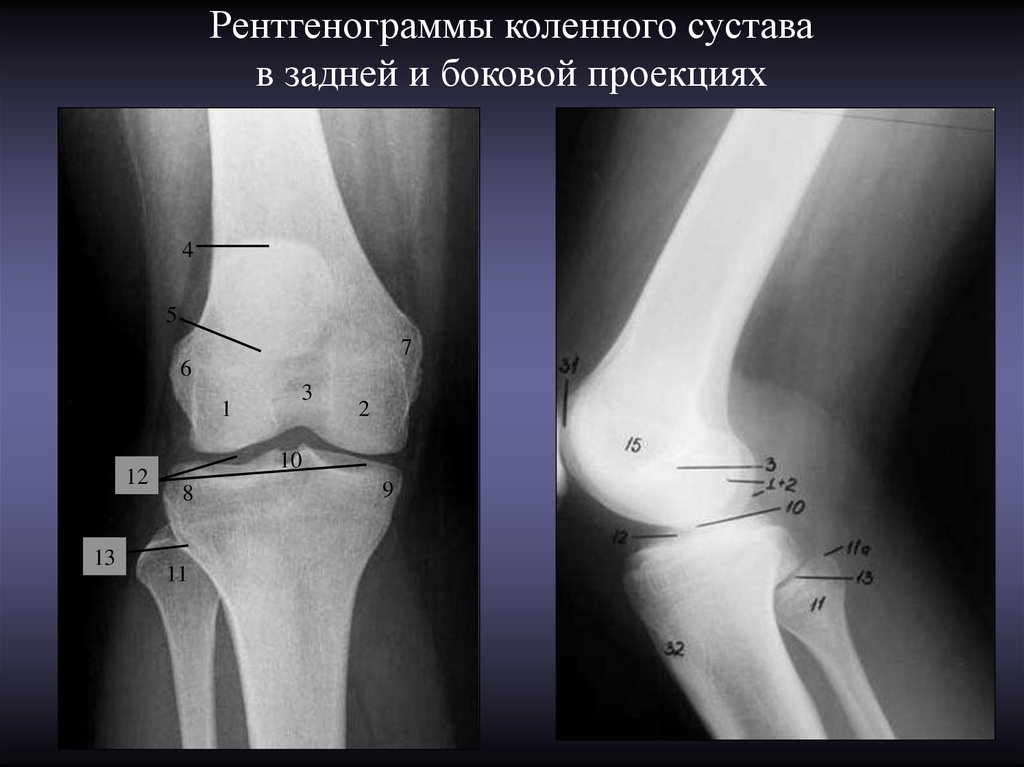 Рентгенограммы коленного сустава в задней и боковой проекциях