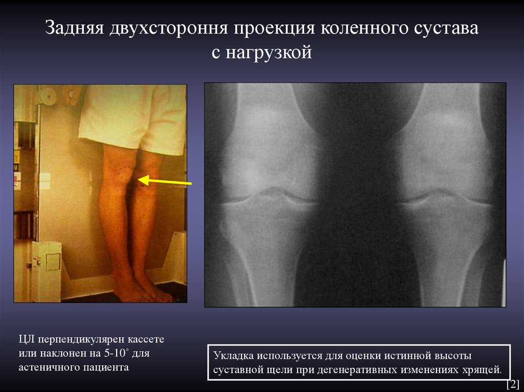 Задняя двухстороння проекция коленного сустава с нагрузкой