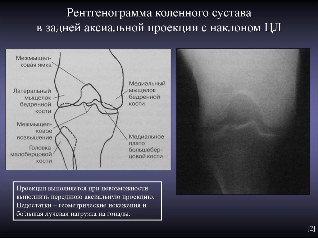 Рентгенограмма коленного сустава в задней аксиальной проекции с наклоном ЦЛ