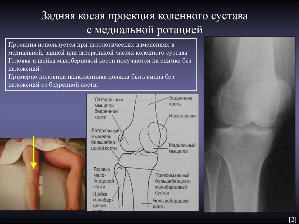 В суставе мыщелок