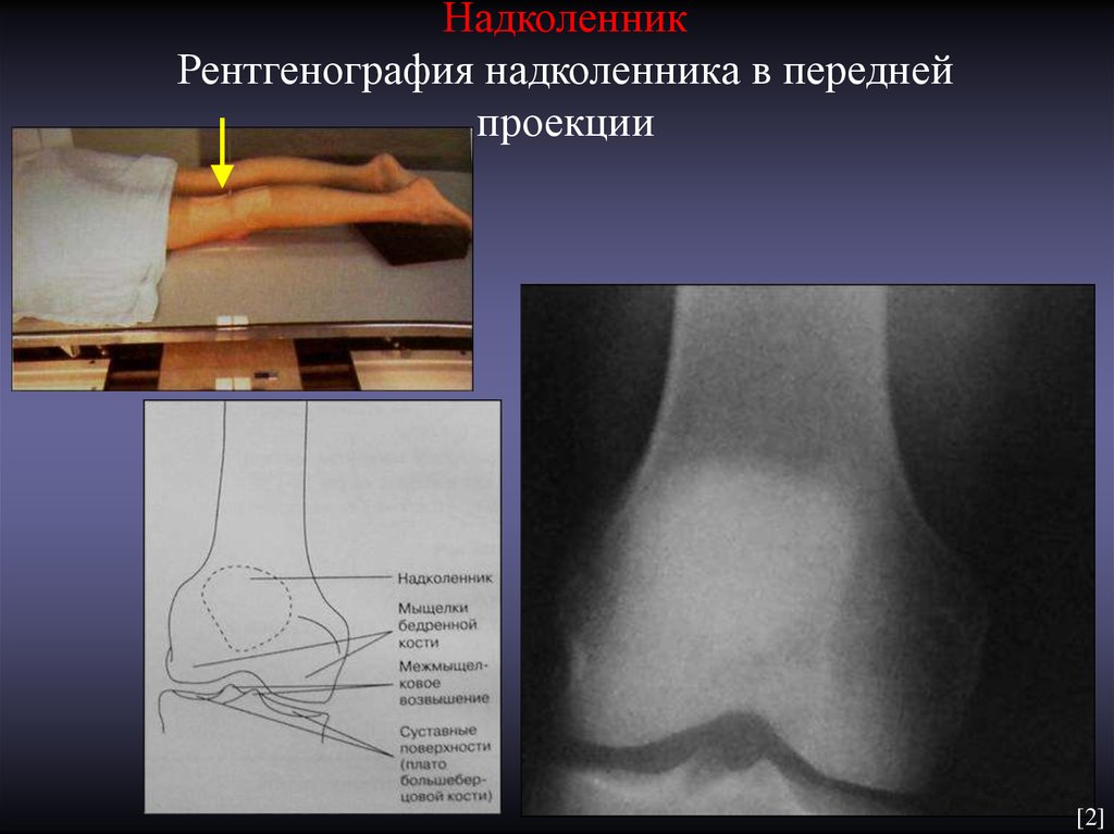 Проекции рентгенографии. Тангенциальная проекция надколенника. Аксиальная проекция надколенника рентген. Рентгенография надколенника в аксиальной проекции. Рентген надколенника в аксиальной проекции укладка.