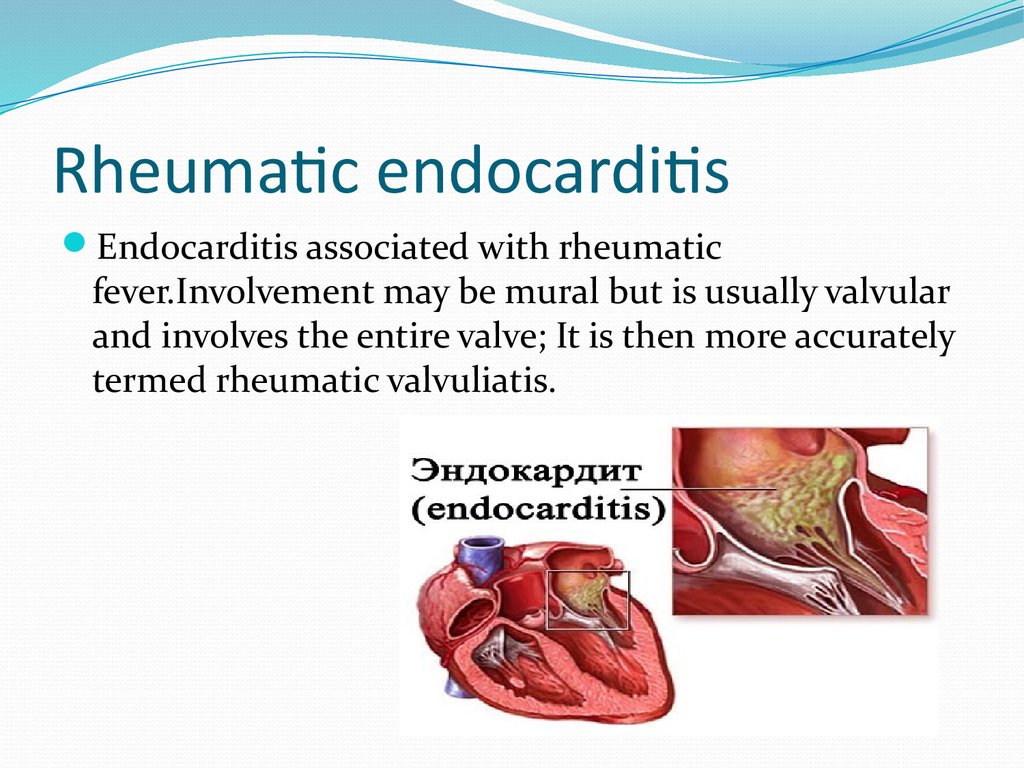 Rheumatic manifestations of infective endocarditis in non-addicts. A 12-year study.