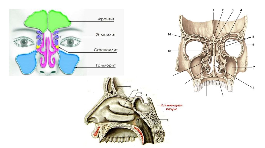 Фронтит что. Синусит фронтит этмоидит сфеноидит. Гайморит фронтит этмоидит. Рентген гайморит фронтит этмоидит.