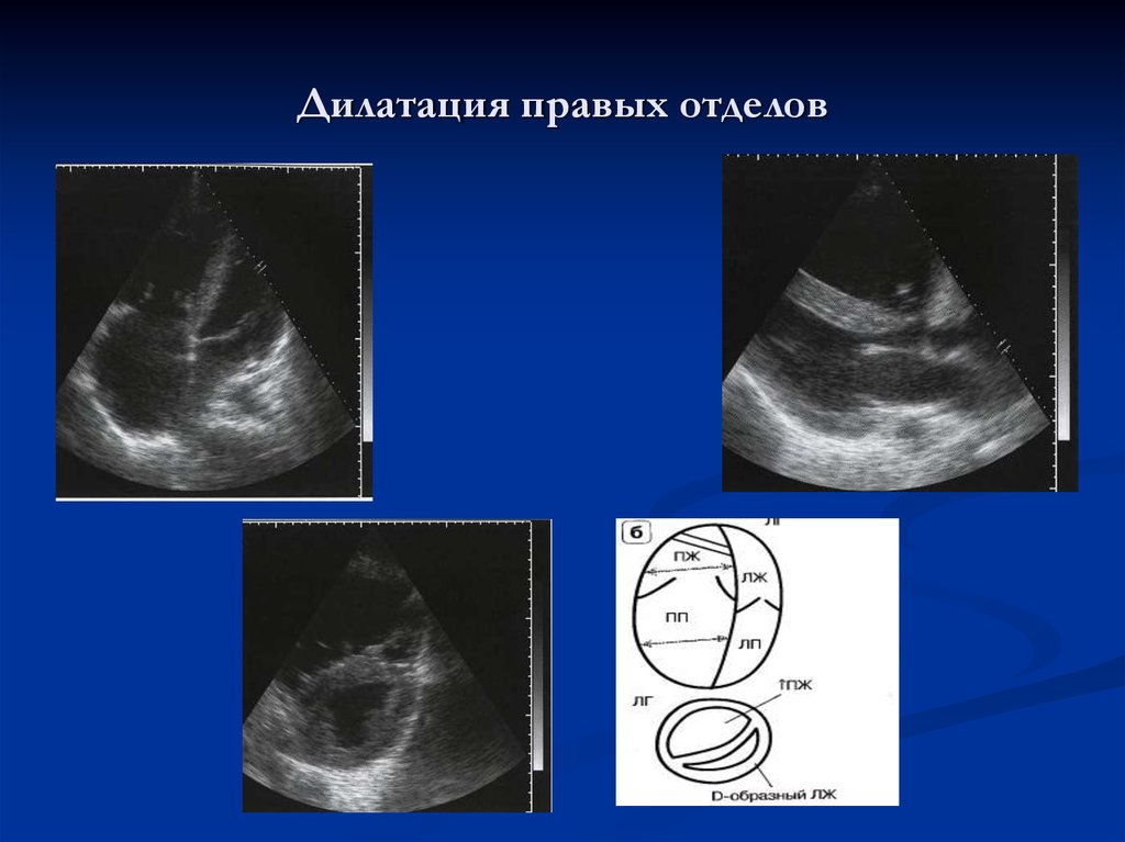 Дилатация правых отделов. Легочная гипертензия эхокардиография. Дилатация правых камер сердца. Дилатация правых отделов ЭХОКГ.