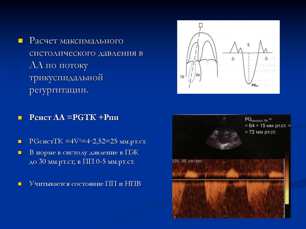 Скорость эхо. Легочная гипертензия по трикуспидальной регургитации. Давление по трикуспидальной регургитации. Расчетное давление в правом желудочке. Пиковая скорость трикуспидальной регургитации.