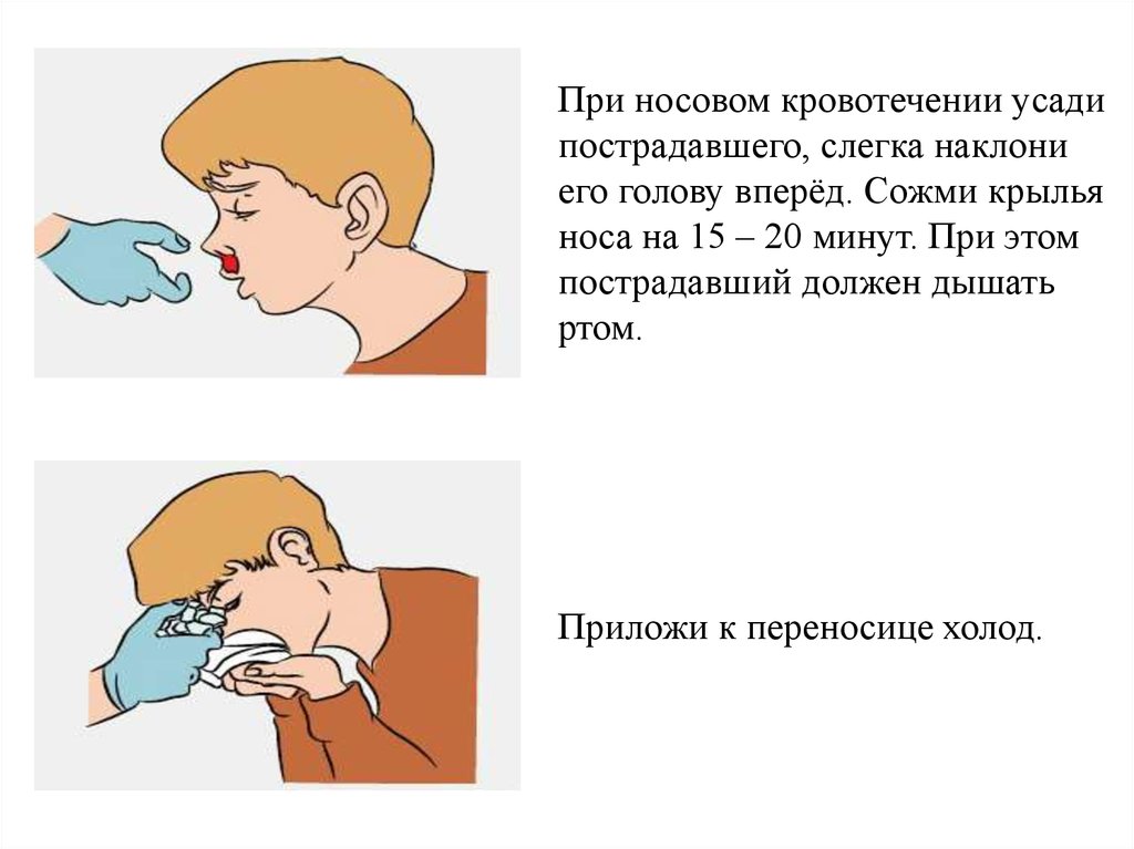 Какие действия необходимо выполнить при носовом кровотечении