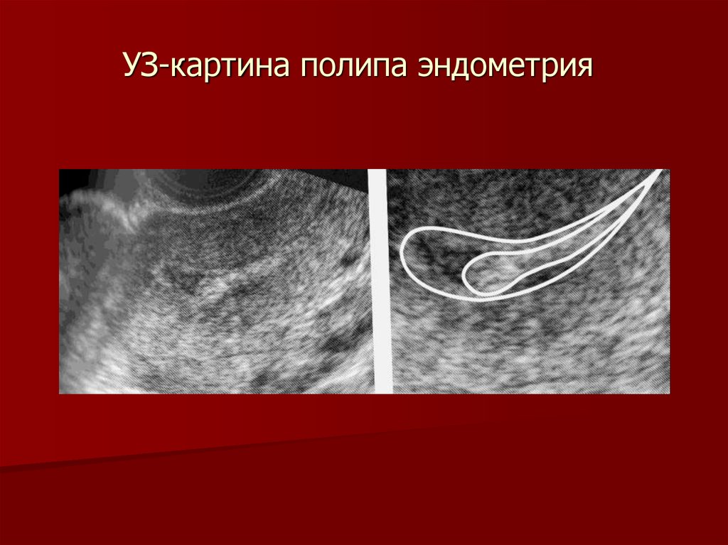 УЗ-картина полипа эндометрия