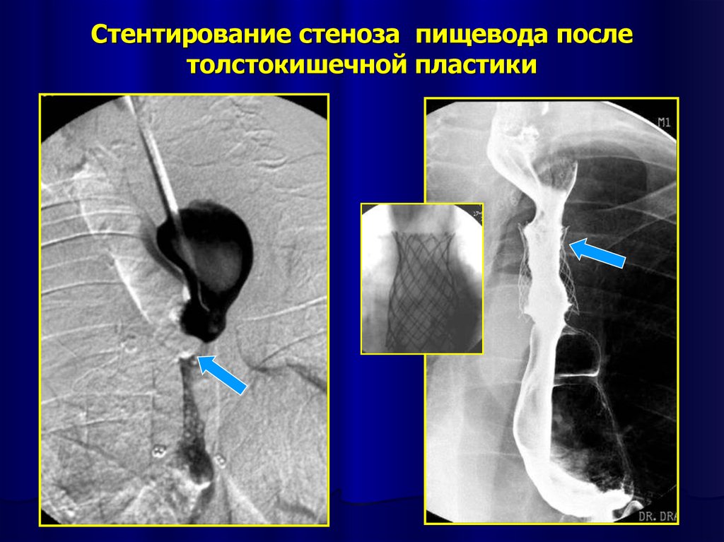 Осложнения стеноза. Стеноз пищевода бужирование. Стентирование пищевода. Стентирования пищевода это. Саморасширяющийся стент пищевода.